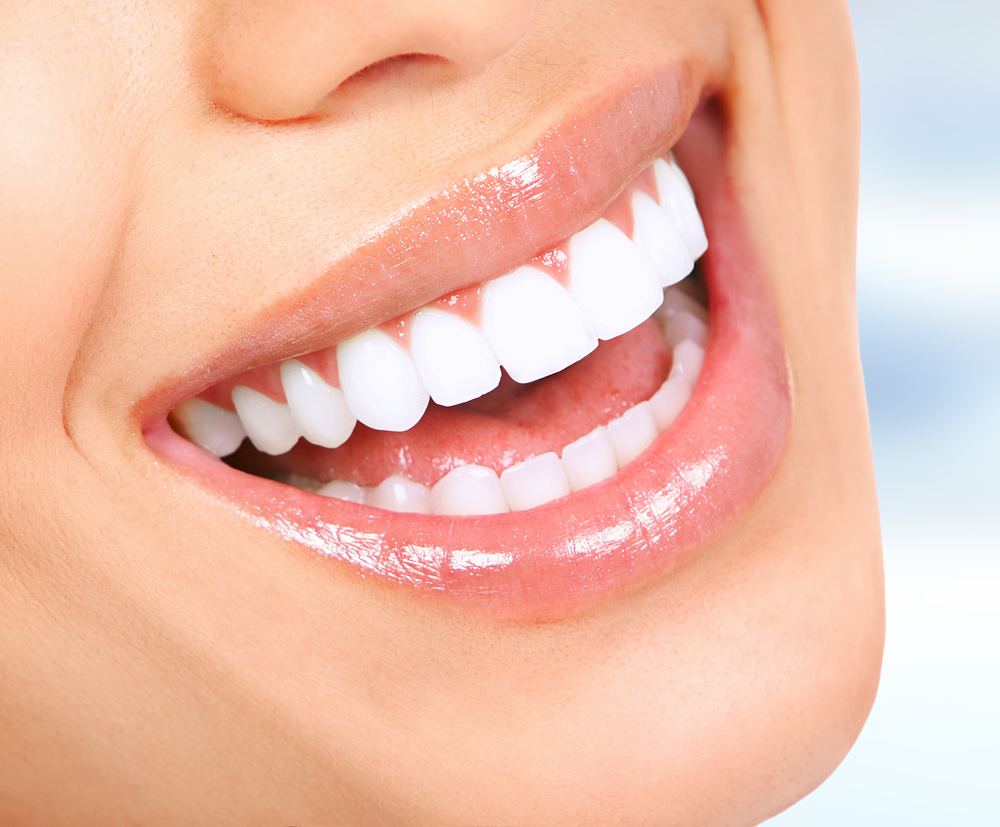 Strahlend weiße Zähne nach Natural Zahnbleaching